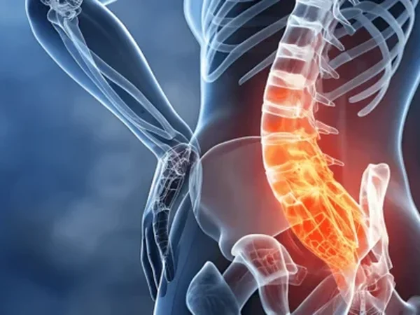 Sciatica